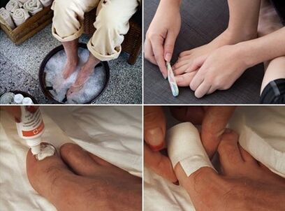 Cozinhar os pés com vapor e aplicar creme de ureia nas unhas afetadas por fungos