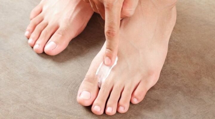 como e como tratar o fungo entre os dedos do pé