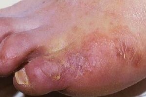 manifestações de uma infecção fúngica na pele das pernas