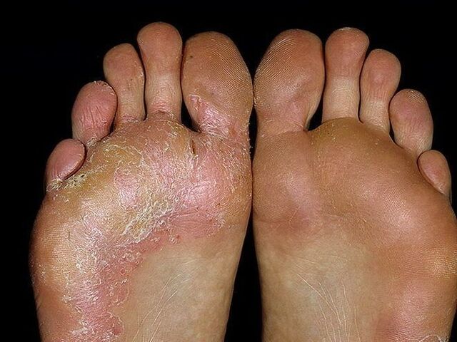 sintomas de um fungo no pé