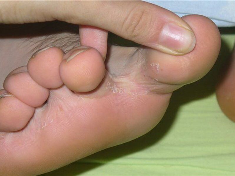 fungo entre os dedos dos pés, foto 1