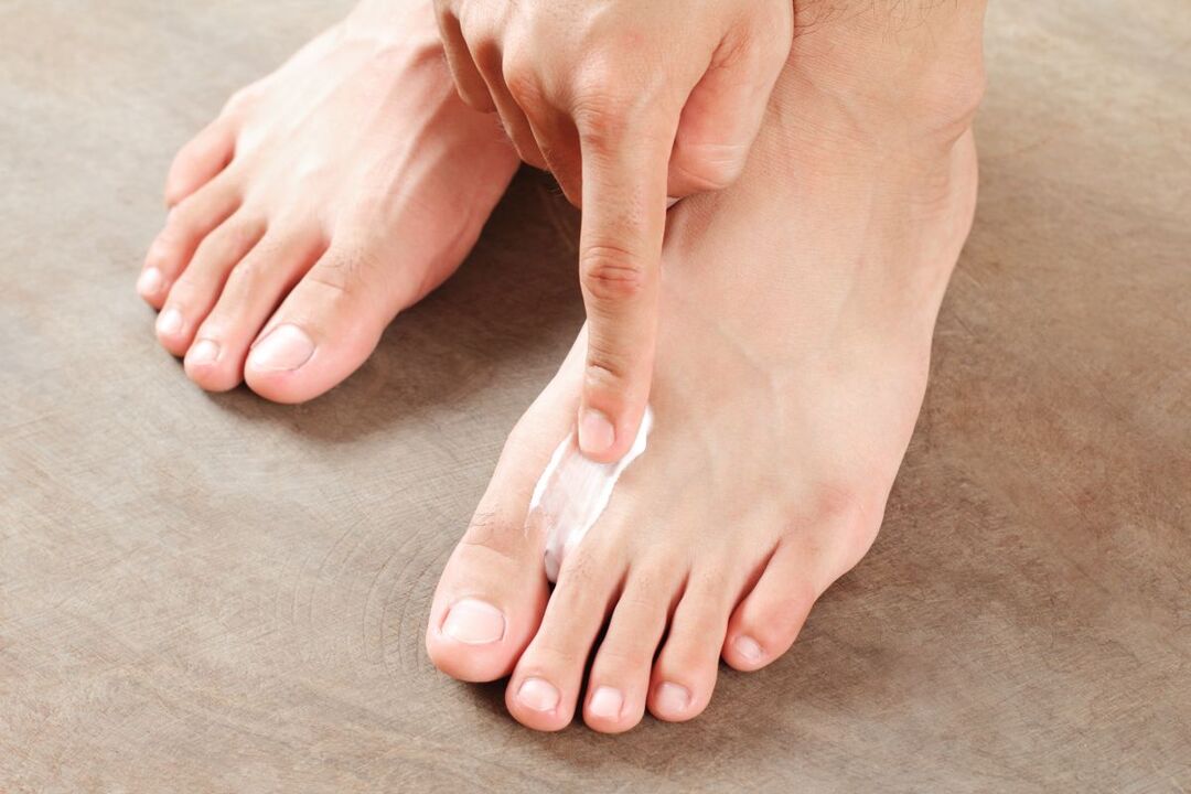 tratamento de fungos nos pés com pomada