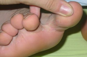 O fungo entre os dedos dos pés
