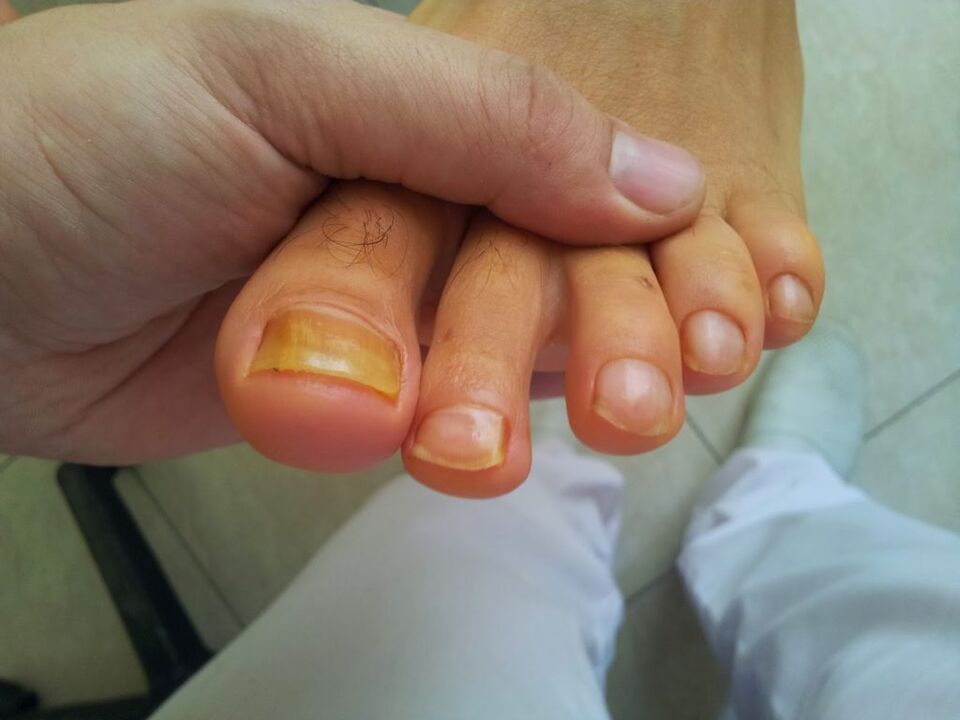 amarelecimento das unhas dos pés com fungos