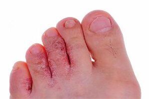 sintomas do fungo do dedo do pé