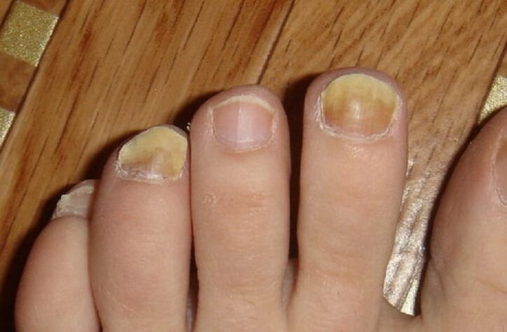 sintomas de fungos nas unhas e na pele dos pés