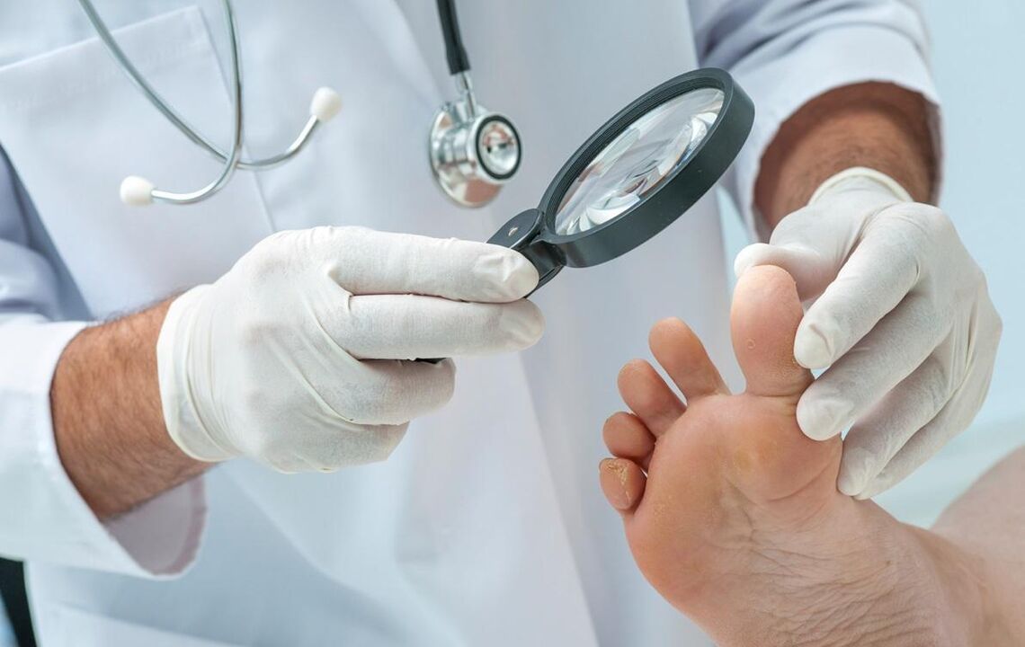 médico examina pés com fungos