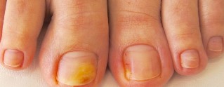 o fungo do prego nos pés sintomas