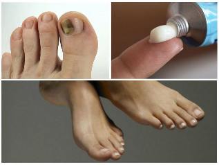 o fungo do prego nos pés tratamento