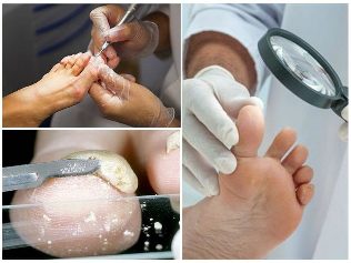 o fungo da pele dos pés diagnóstico