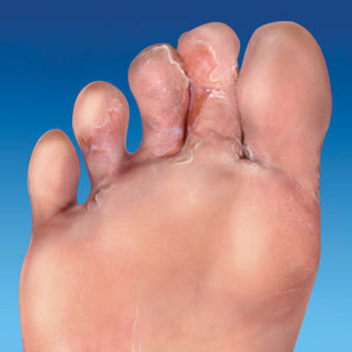 o fungo da pele dos pés