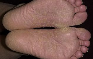 o fungo pés